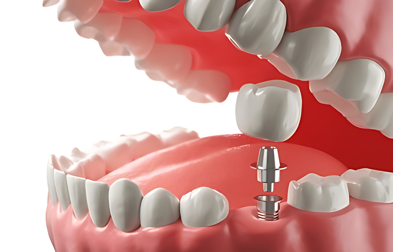 dental-implant-istanbul-turkey