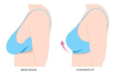 breast-uplift-istanbul