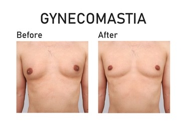 gynecomastia-male-breast-reduction-istanbul