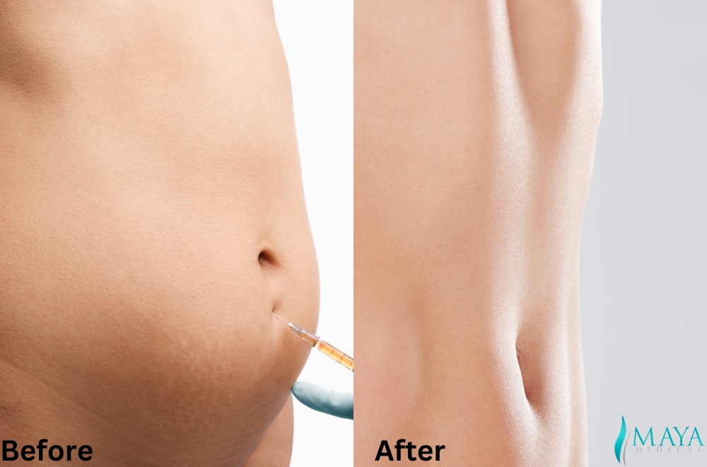 liposuction-before-after-antalya-turkey