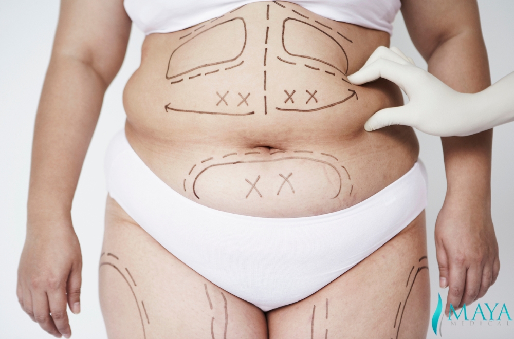 raditional-liposuction-antalya-turkey