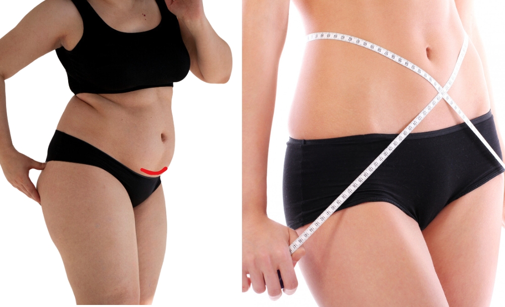 mini-tummy-tuck-before-after-results