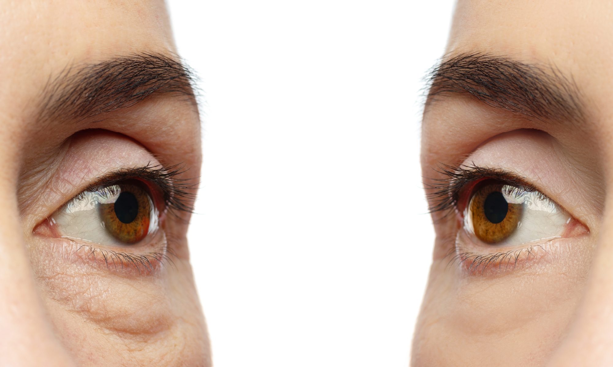 blepharoplasty-before-after-istanbul