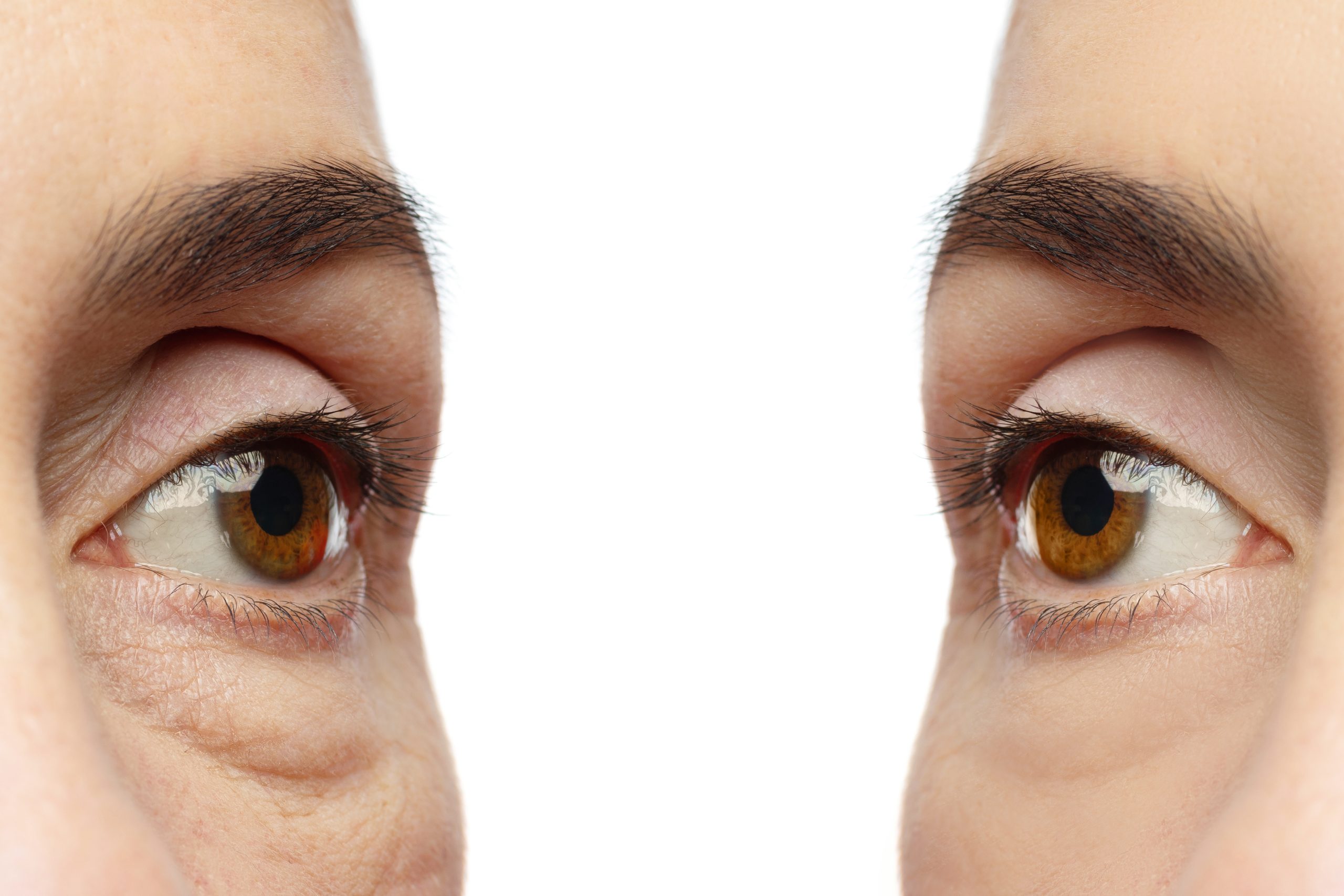 blepharoplasty-before-after-istanbul