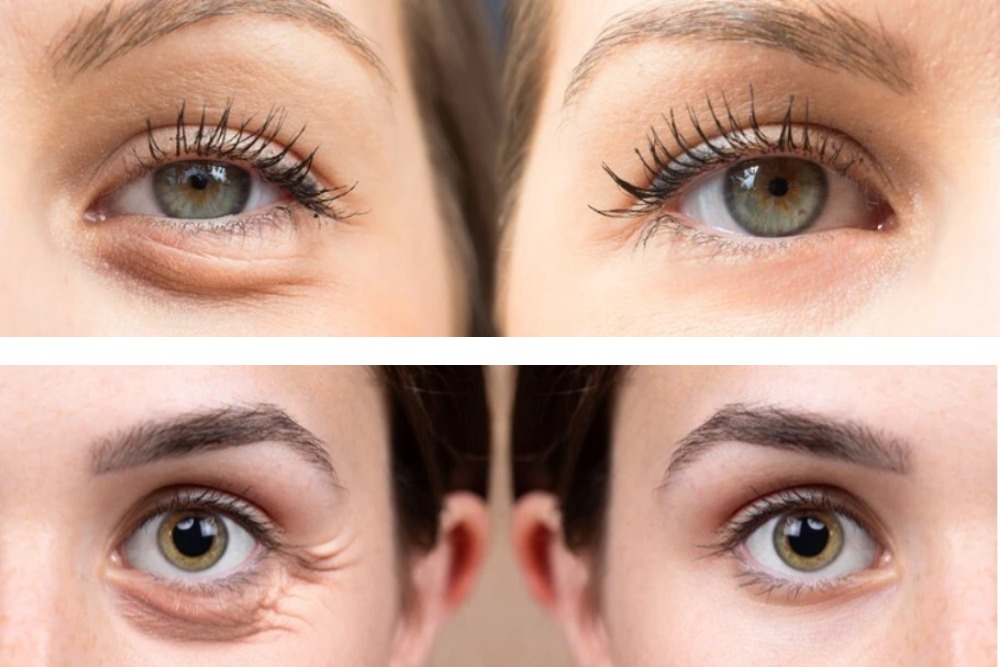 blepharoplasty-eyelid-surgery-before-and-after