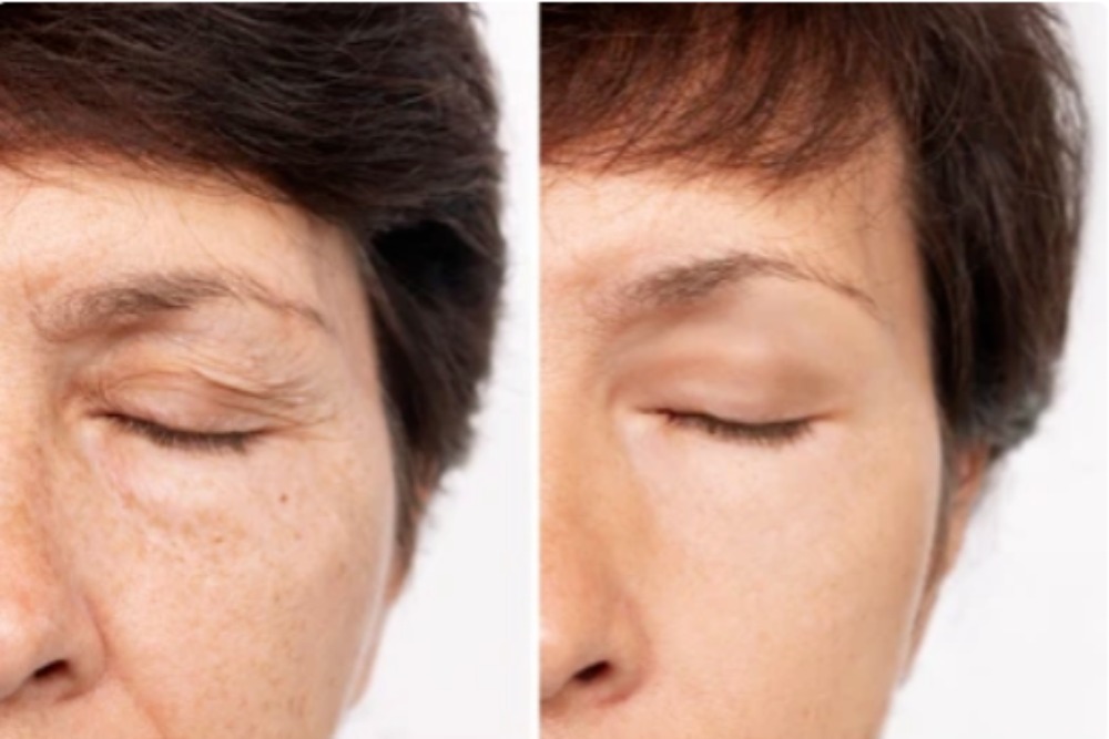 blepharoplasty-eyelid-surgery-before-and-after