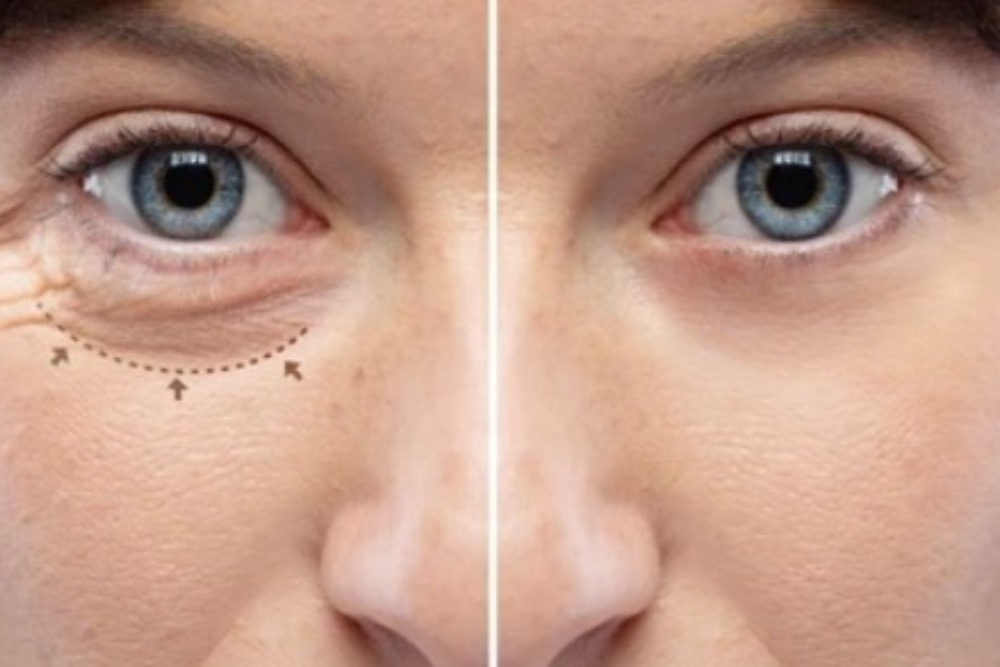 blepharoplasty-eyelid-surgery-before-and-after