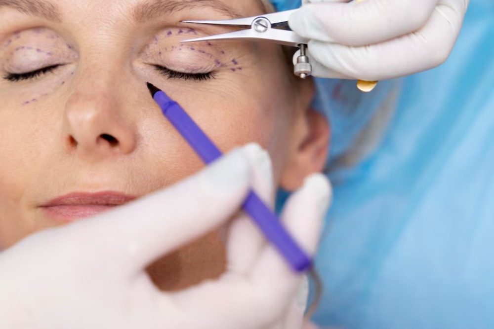 blepharoplasty-eyelid-surgery