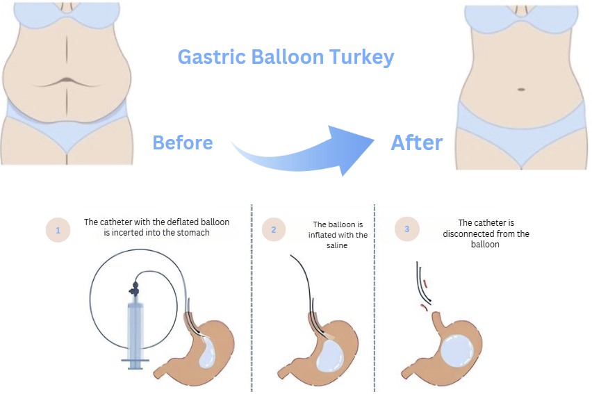 gastric-balloon-turkey