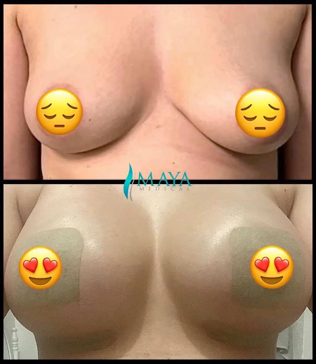 breast-augmentation-scars