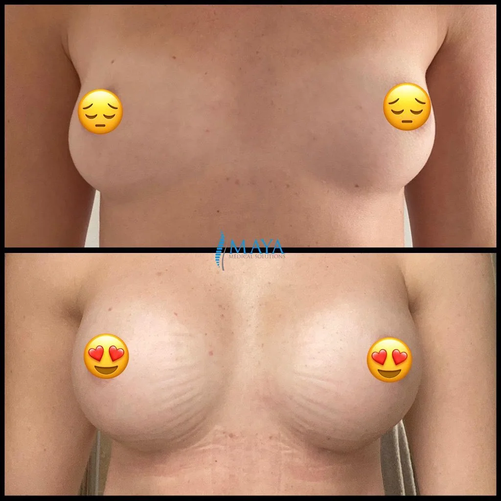 breast-augmentation-scars