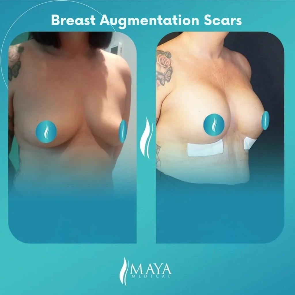  breast-augmentation-scars-before-after-istanbul