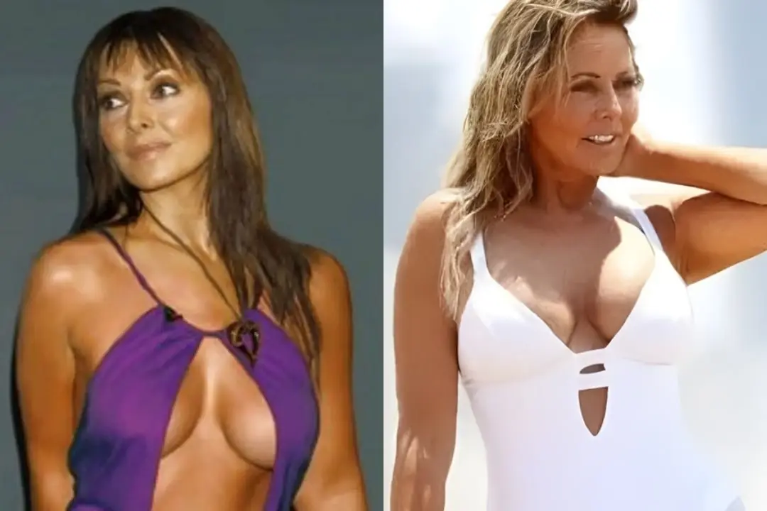 carol-vorderman-boobs-surgery