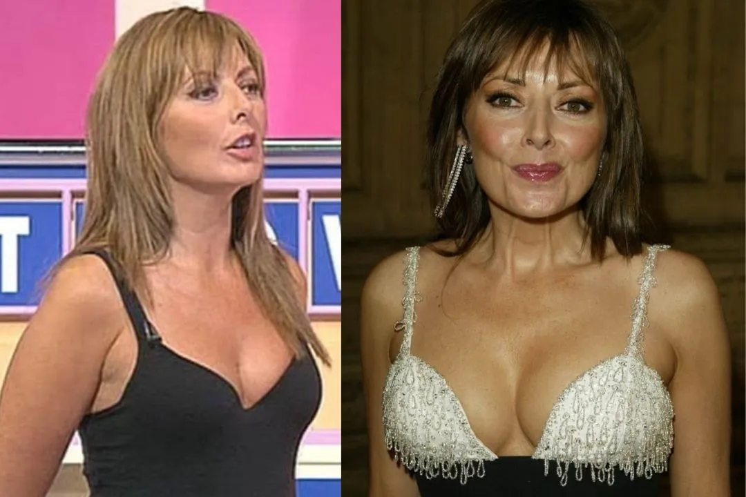 carol-vorderman-breast-augmentation