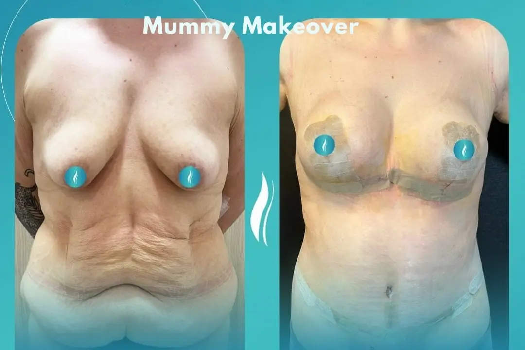 mummy-makeover