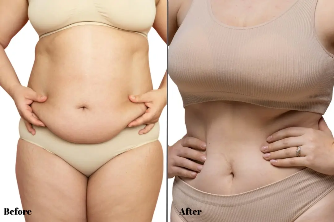 apron-belly-before-after