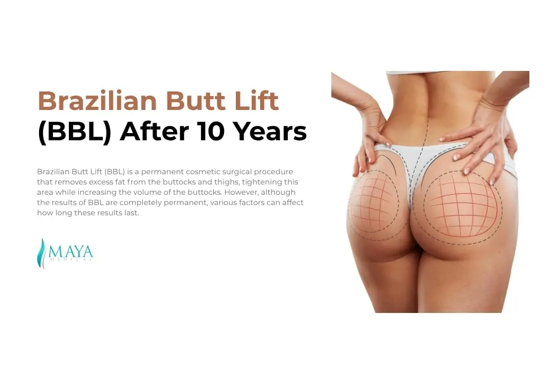 bbl-after-10-years