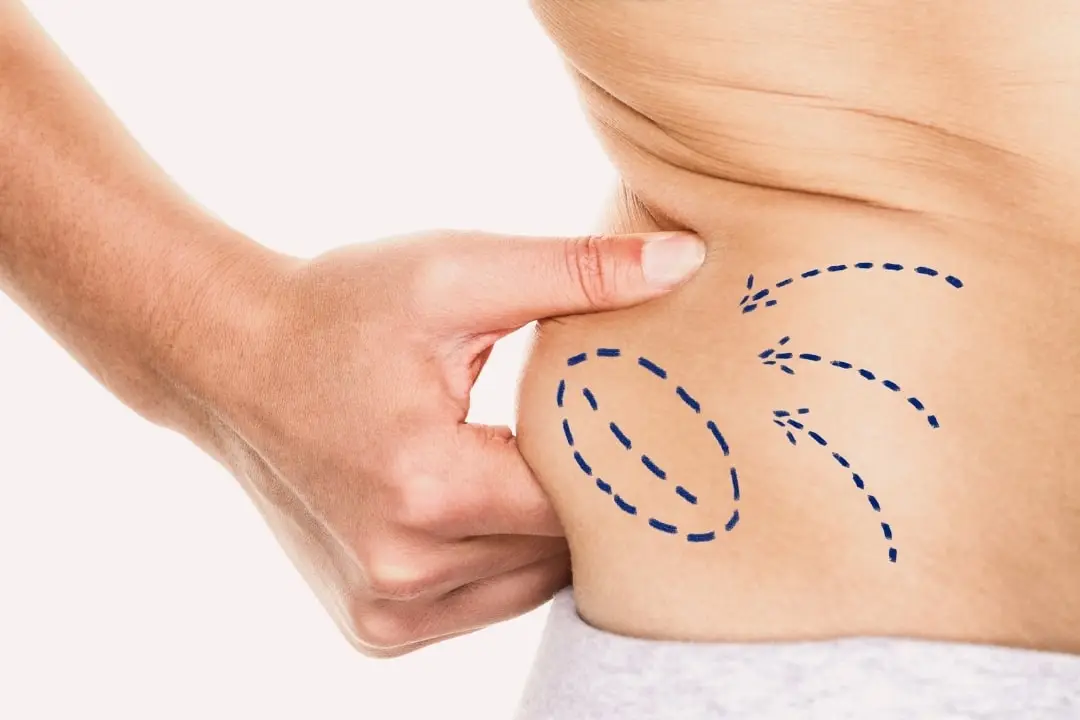 liposuction-scars
