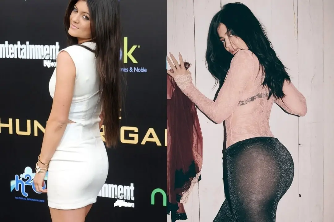 kylie-jenner-bbl-before-and-after