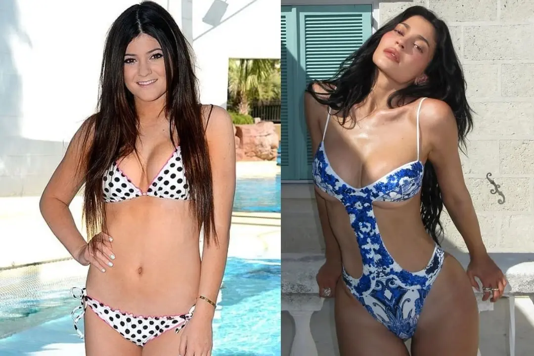 kylie-jenner-body-aesthetics-before-and-after