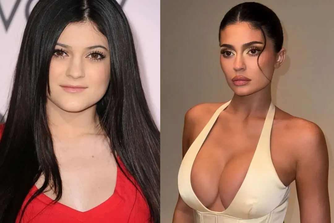 kylie-jenner-breast-before-and-after
