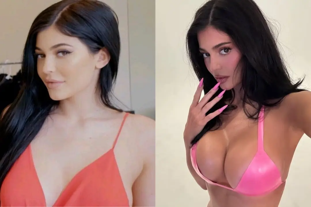 kylie-jenner-breast-aesthetics-before-and-after-