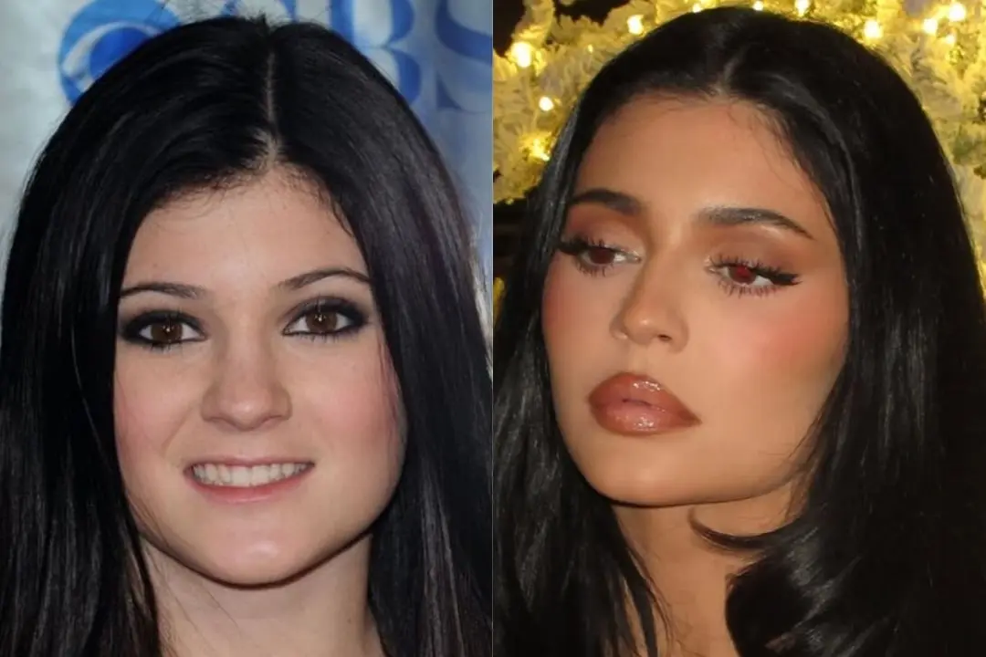 kylie-jenner-chin-augmentation-before-and-after-