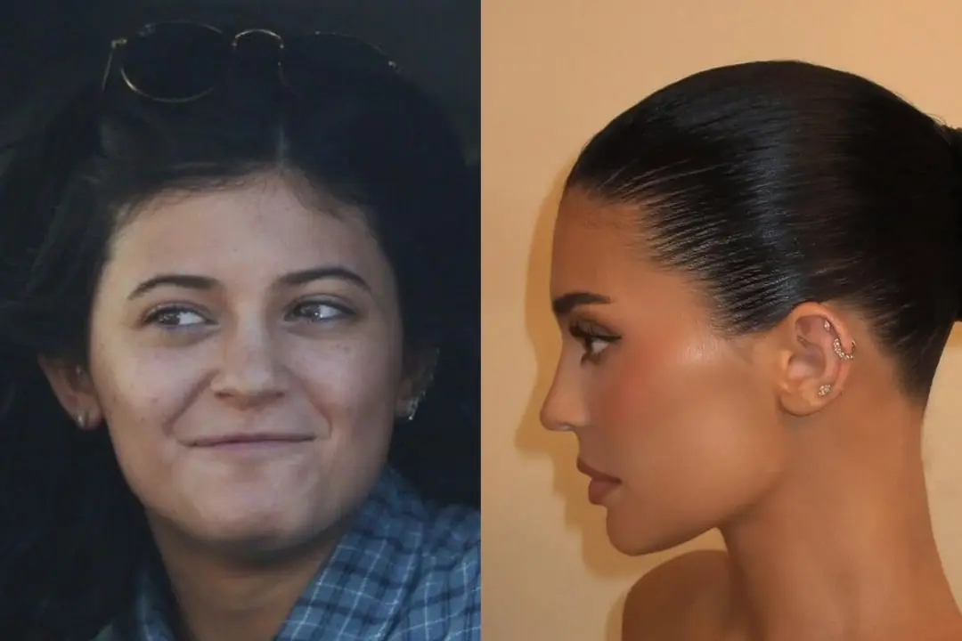 kylie-jenner-rhinoplasty-before-and-after
