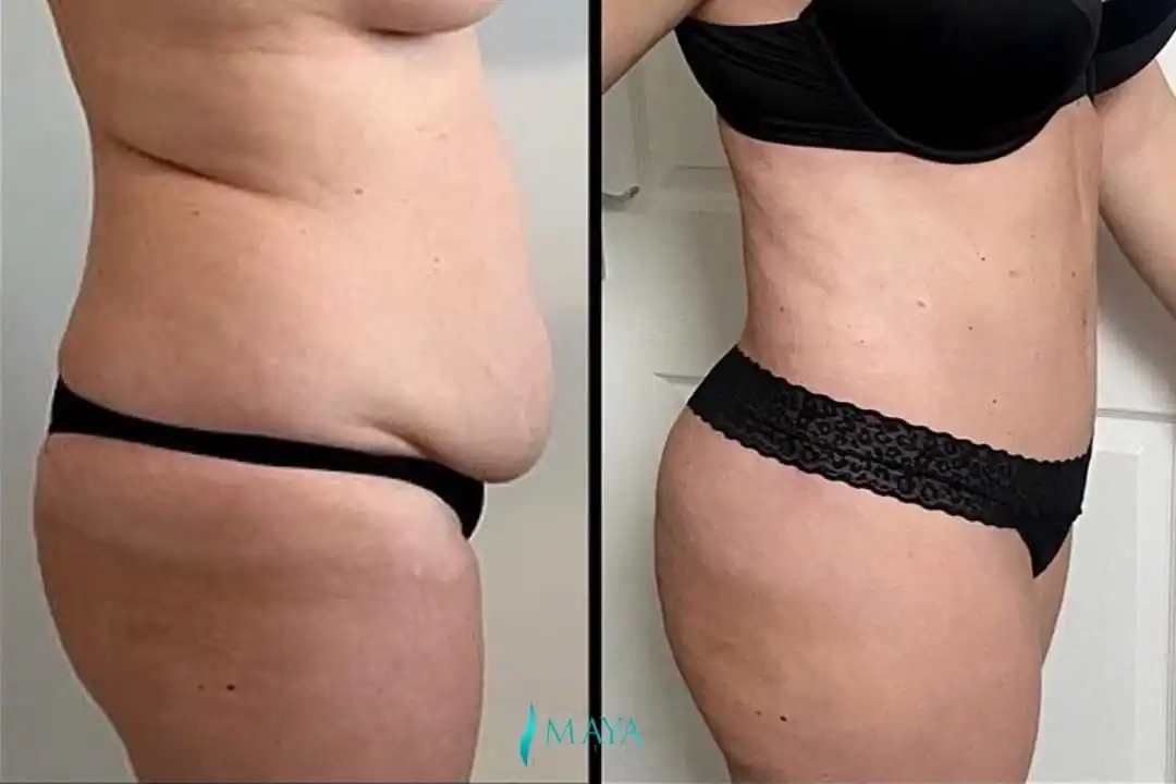 how-to-avoid-loose-skin-after-weight-loss