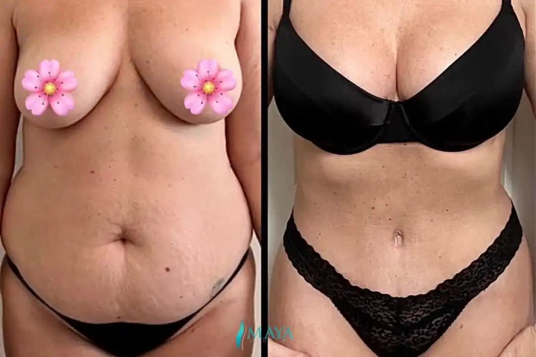 how-to-avoid-loose-skin-after-weight-loss