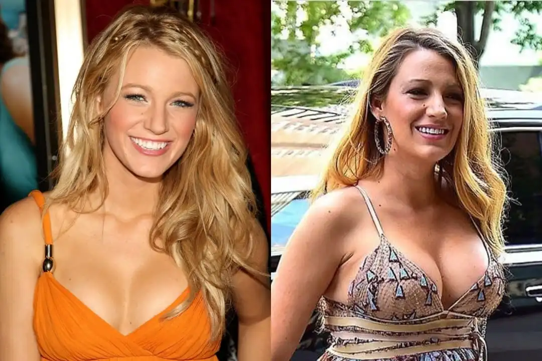 Blake Lively breast augmentation