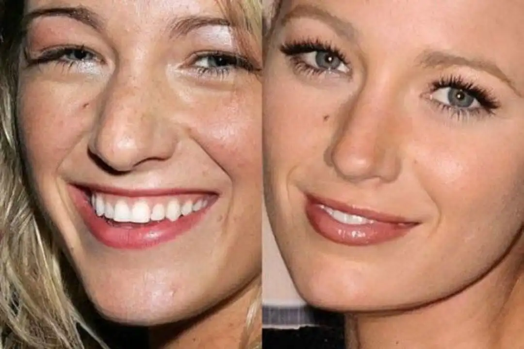 Blake Lively breast blepharoplasty