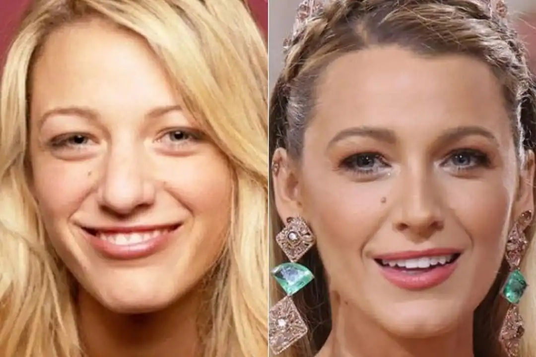Blake Lively nose job