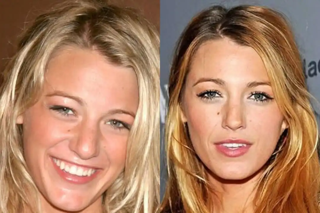 Blake Lively plastic surgery before after