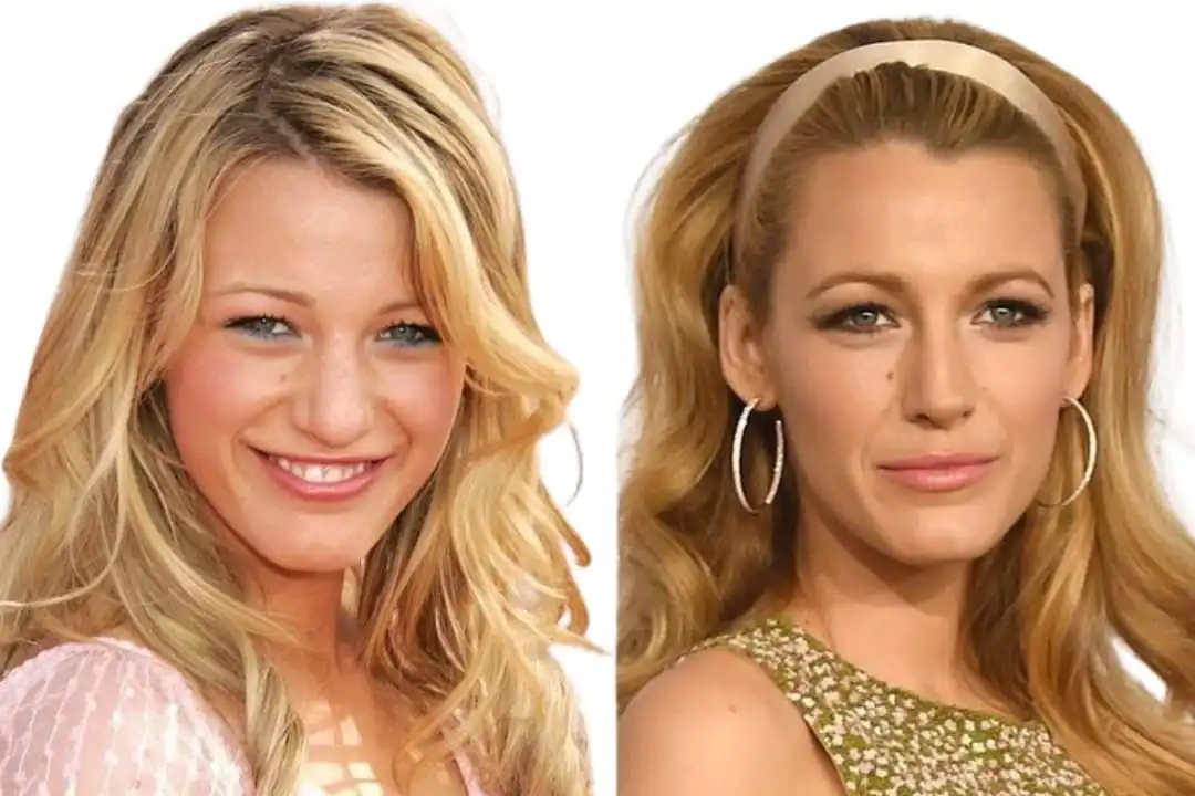 Blake Lively rhinoplasty